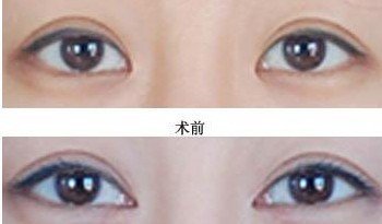 开内眼角术后的注意事项