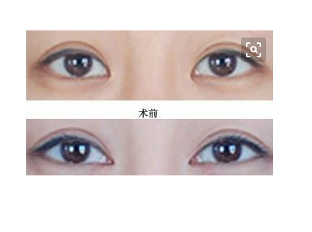 韩式无痕开眼角的效果好吗