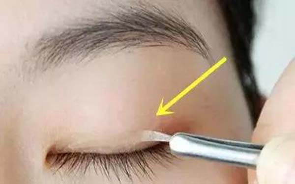 双眼皮全切加开眼角多少钱