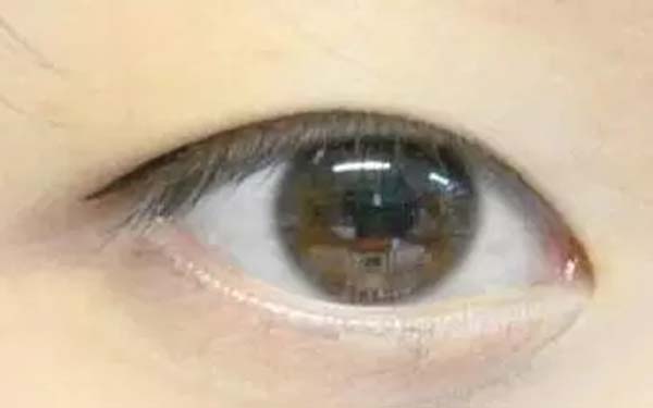 开眼角一般都是多少钱