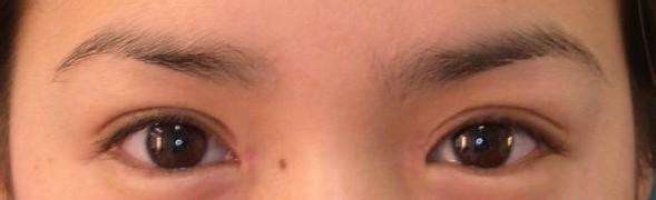 开眼角手术适宜人群