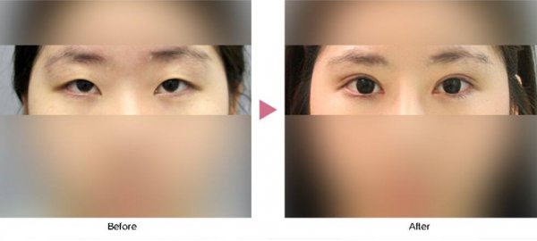 如何挑选开外眼角手术方法