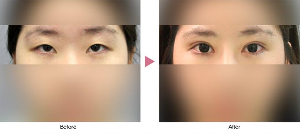 如何挑选开外眼角手术方法