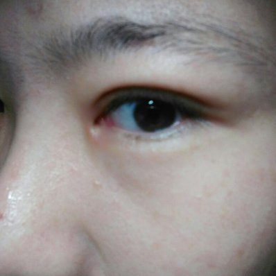 外眼角美容手术方法介绍