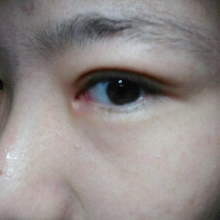 外眼角美容手术方法介绍