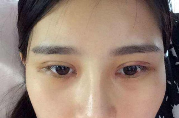 开眼角手术的手术方法