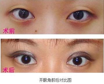 开眼角术多久恢复