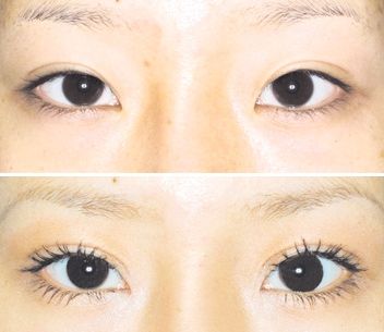 上海韩式无痕开眼角多少钱