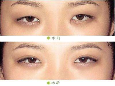 做开眼角术后护理