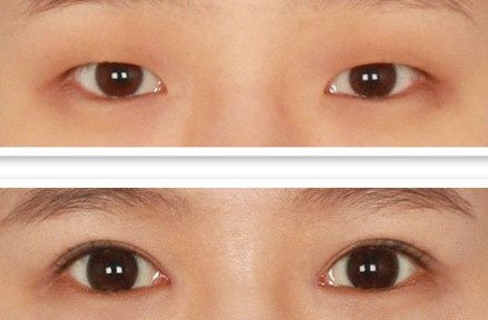 开外眼角手术前需要做什么准备工作吗