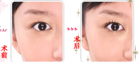 开外眼角术后效果对比