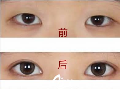 开外眼角失败的原因