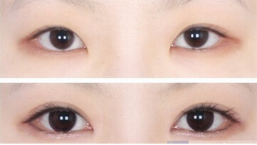 开眼角手术前要注意什么