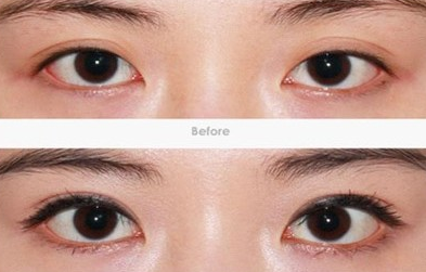 开眼角手术失败了该怎么办
