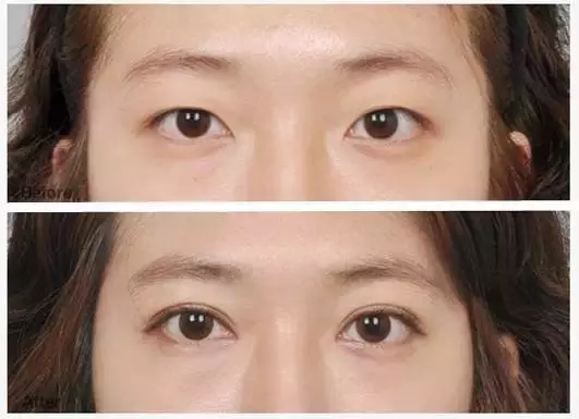 绍兴开眼角手术价格