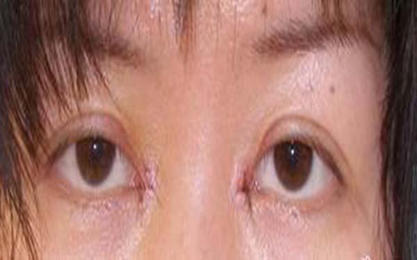 北京开眼角手术一般价格是多少