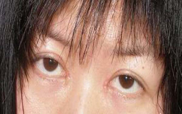 韩式开眼角手术安全吗