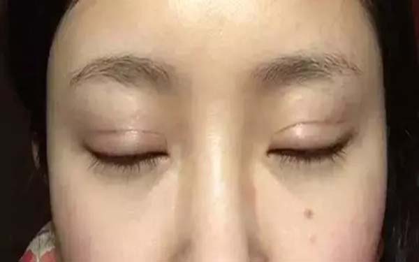 开眼角术效果好吗