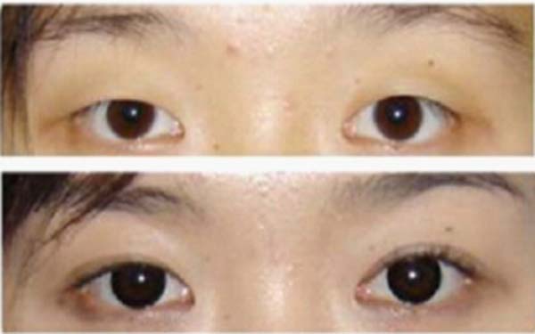 开眼角手术后多久可以化妆