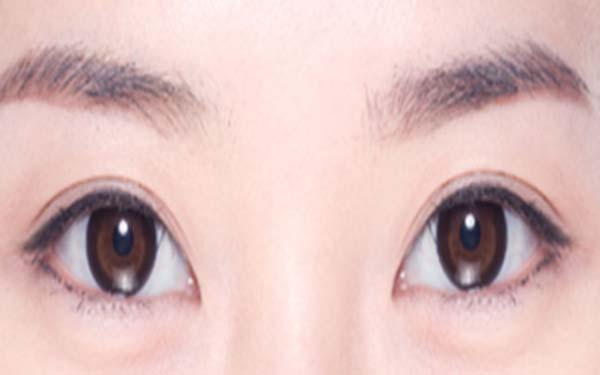 开眼角伤口多久能愈合