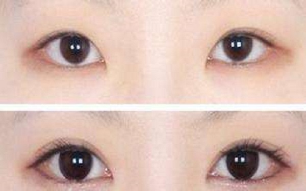 开双眼皮加开眼角手术价钱是多少