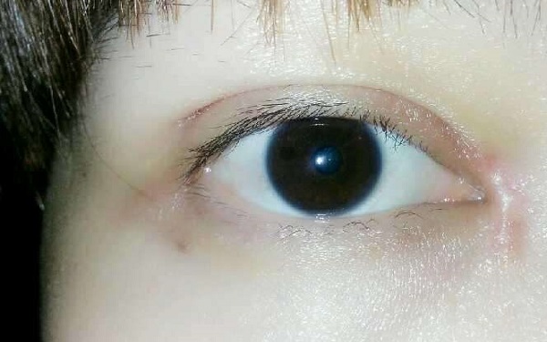 开眼角7天恢复效果好不好