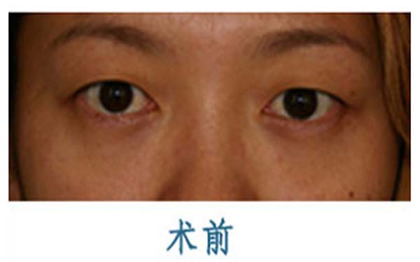 开外眼角手术适合哪些人群