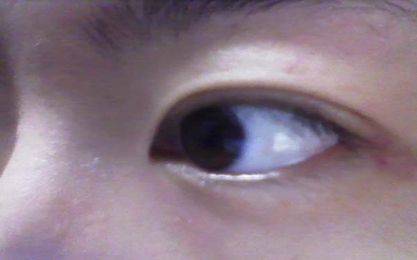 如何保证开眼角手术的效果