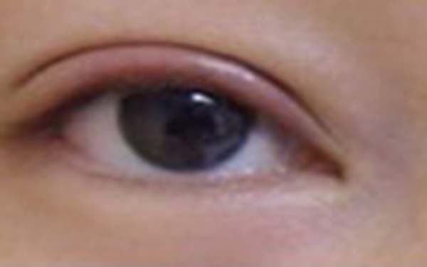 北京开外眼角手术效果