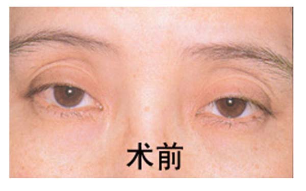导致开眼角手术失败的原因有哪些