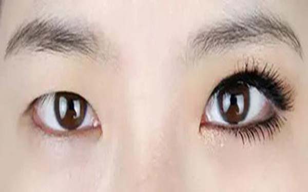 开外眼角手术的术后护理