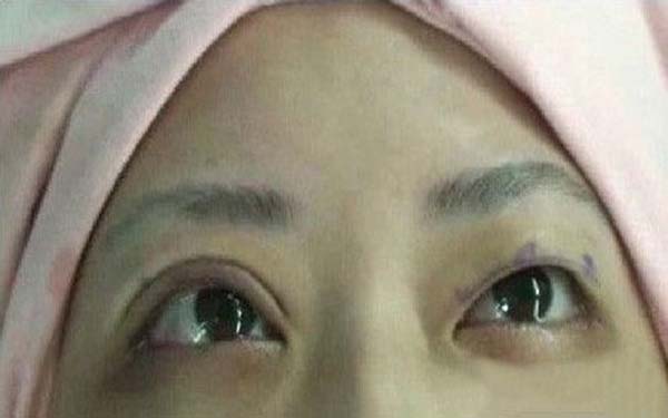 开眼角术的护理要注意什么