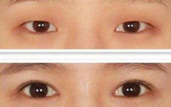 开眼角术优缺点对比