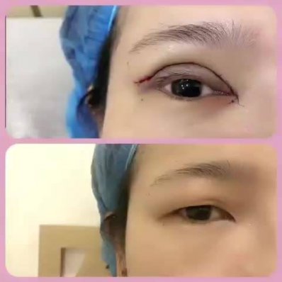 北京小眼开大费用是多少