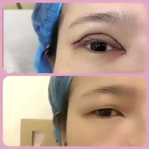 北京小眼开大费用是多少