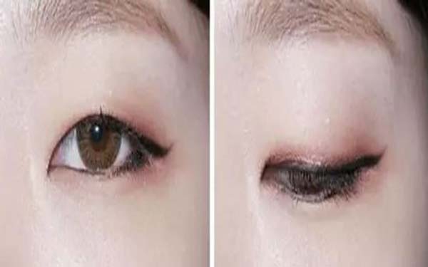 开眼角整形的5大作用详解