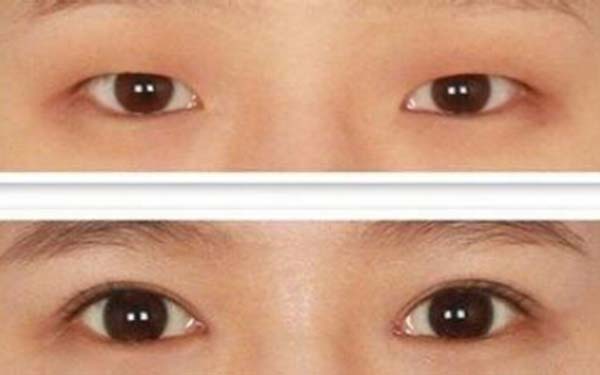 北京开外眼角效果好不好