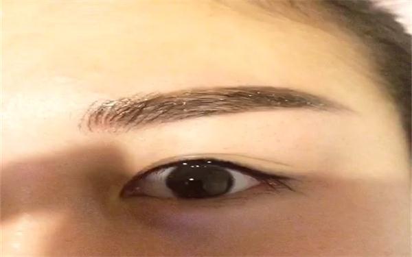 你知道开内眼角手术过程吗？