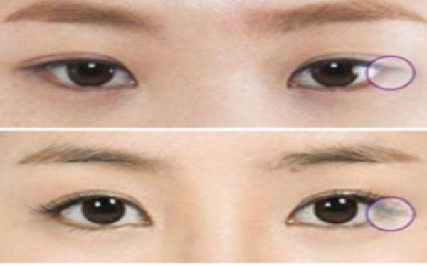 哪些人适合开眼角?