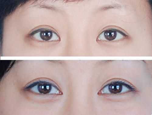 不适合开眼角的人群有哪些