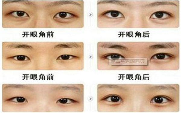 哪种眼睛适合开眼角?