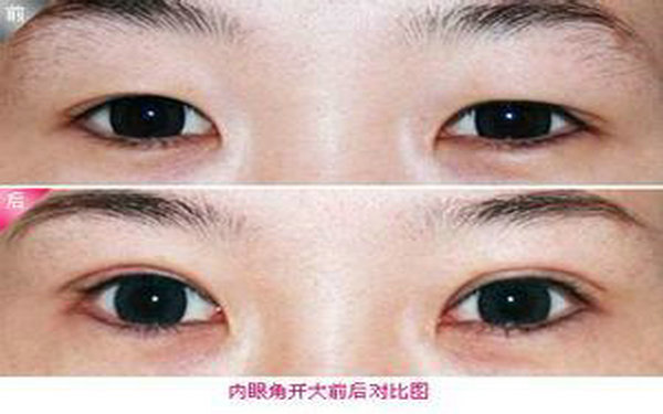 哪里开眼角较好?