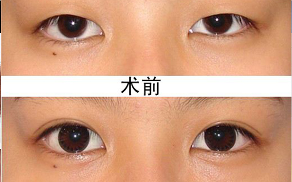 开眼角一定会出现疤痕吗