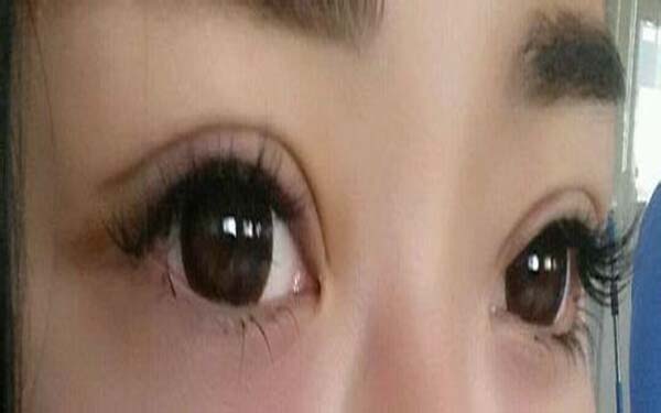 韩式开眼角后有什么注意事项