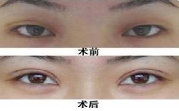 全切双眼皮加开眼角恢复全过程