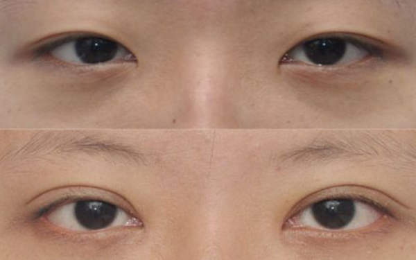 开眼角有后遗症怎么办
