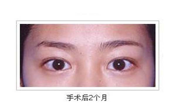 开外眼角前后对比照的效果怎么样