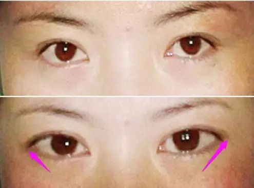 开外眼角的效果
