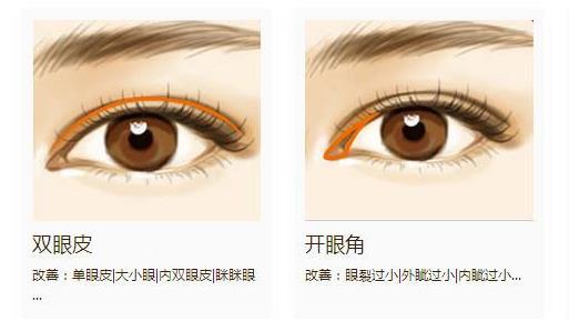 开眼角会变成双眼皮吗