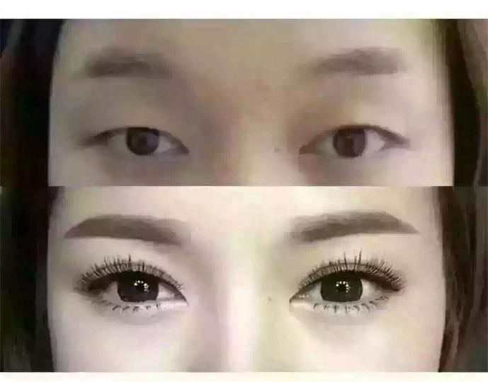 开眼角和割双眼皮恢复期